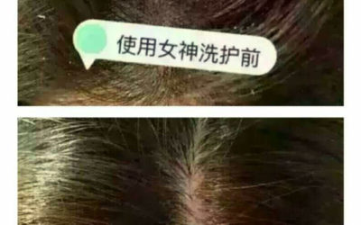 使用两个月后清除头皮屑
